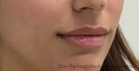 Restylane Before & After Patient #8108
