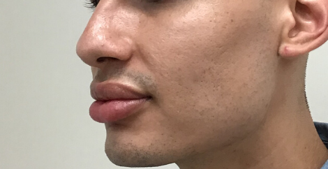 Nose Thread Before & After Patient #8105