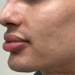 Nose Thread Before & After Patient #8105