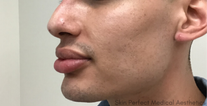 Nose Thread Before & After Patient #8105