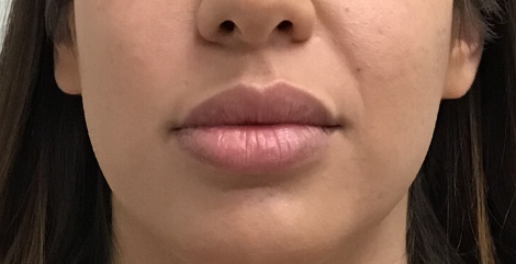 Restylane Before & After Patient #8102