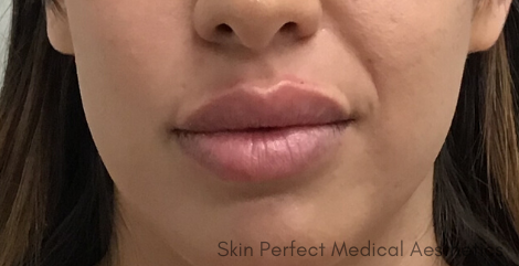 Restylane Before & After Patient #8102
