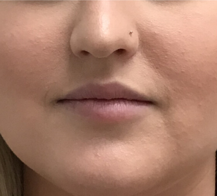 Restylane Before & After Patient #8096
