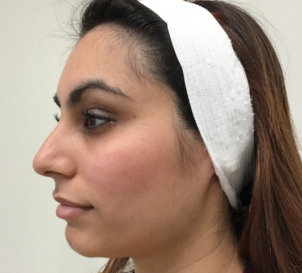 Thread Lift Before & After Patient #8093
