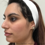 Thread Lift Before & After Patient #8093