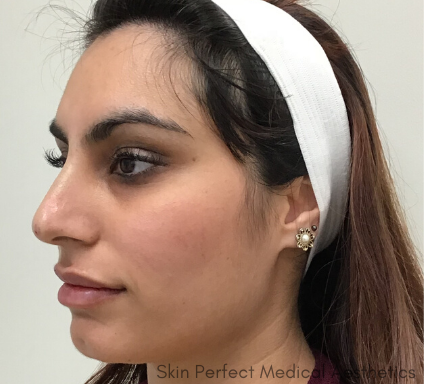Thread Lift Before & After Patient #8093