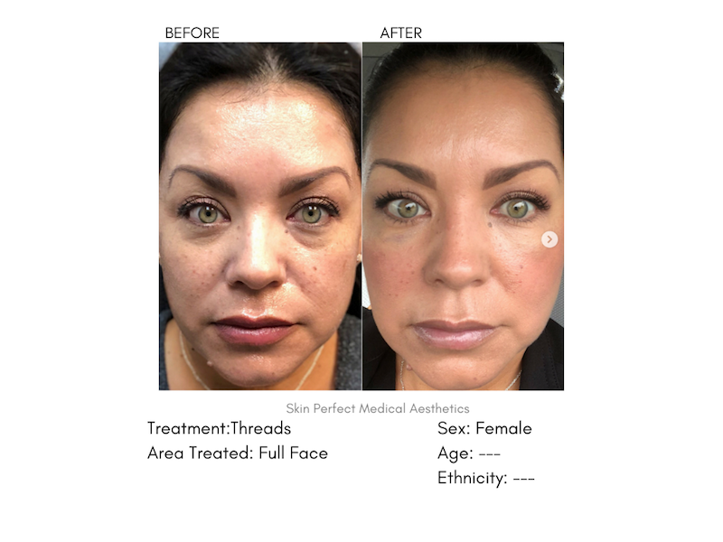 PDO Threadlift Los Angeles