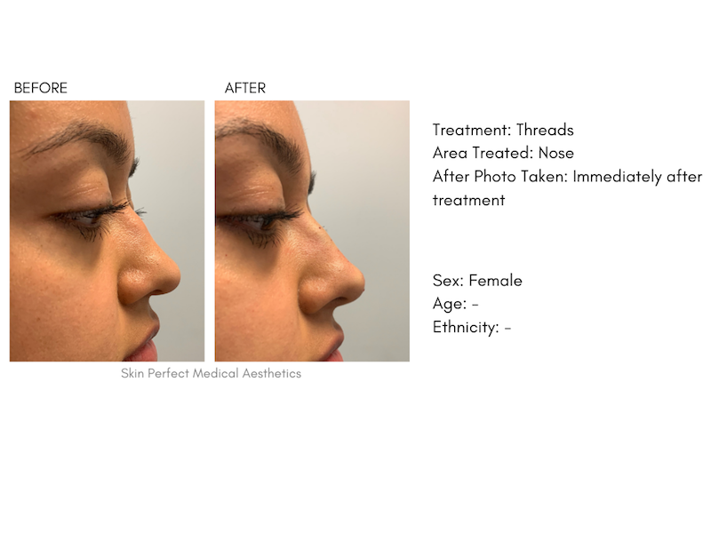 Threading Treatment  Brow, Chin, Forehead, Neck, Face & Lips