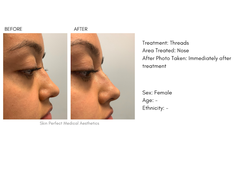 pdo thread lift jawline before and after