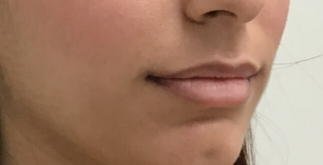 Restylane Kysse Before & After Patient #8968