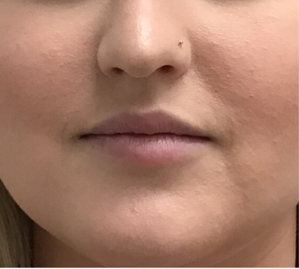 Restylane Kysse Before & After Patient #8971