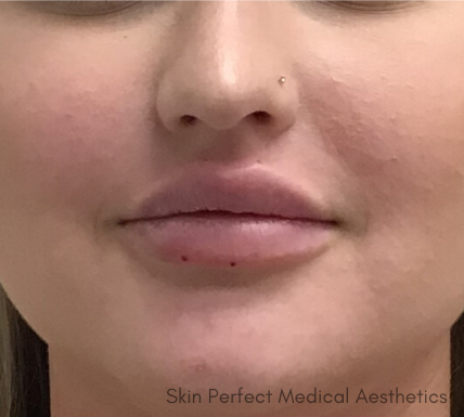 Restylane Kysse Before & After Patient #8971