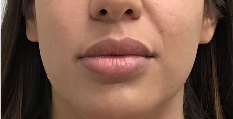 Restylane Kysse Before & After Patient #8974