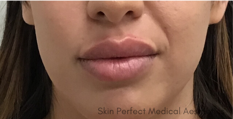 Restylane Kysse Before & After Patient #8974