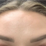 Botox, Dysport, & Xeomin Before & After Patient #8923