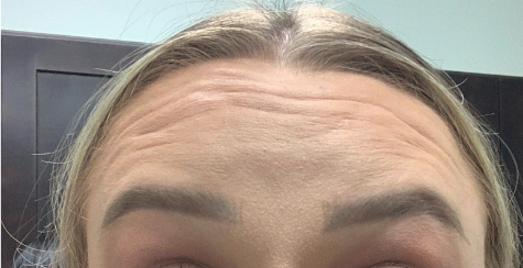 Botox, Dysport, & Xeomin Before & After Patient #8923