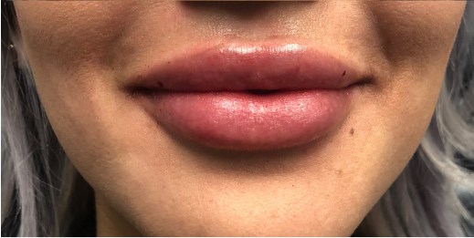 Restylane Before & After Patient #8953