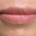 Restylane Before & After Patient #8937