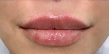 Restylane Before & After Patient #8937