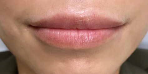 Restylane Before & After Patient #8937