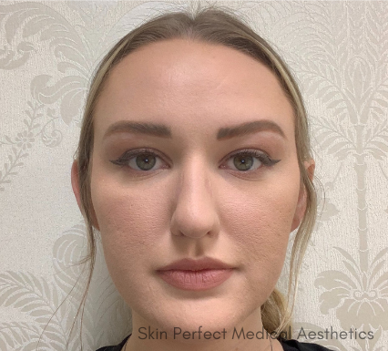 Restylane Lyft Before & After Patient #8916