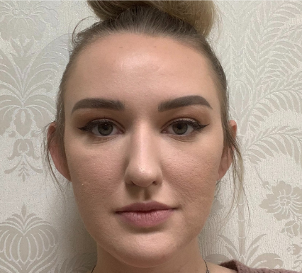 Restylane Lyft Before & After Patient #8916