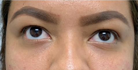 Restylane Lyft Before & After Patient #8934