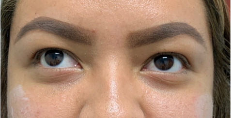 Restylane Lyft Before & After Patient #8934