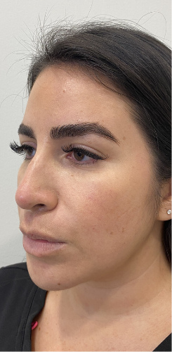 Thread Lift Before & After Patient #8940