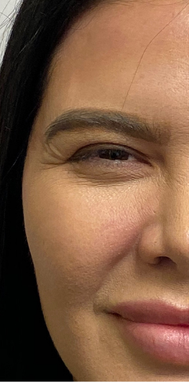 Botox, Dysport, & Xeomin Before & After Patient #8944