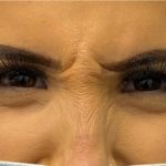 Botox, Dysport, & Xeomin Before & After Patient #8947