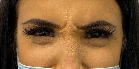 Botox, Dysport, & Xeomin Before & After Patient #8947