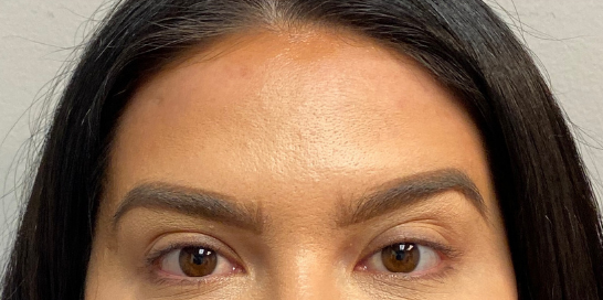Botox, Dysport, & Xeomin Before & After Patient #8950