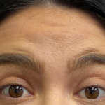 Botox, Dysport, & Xeomin Before & After Patient #8950