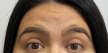 Botox, Dysport, & Xeomin Before & After Patient #8950