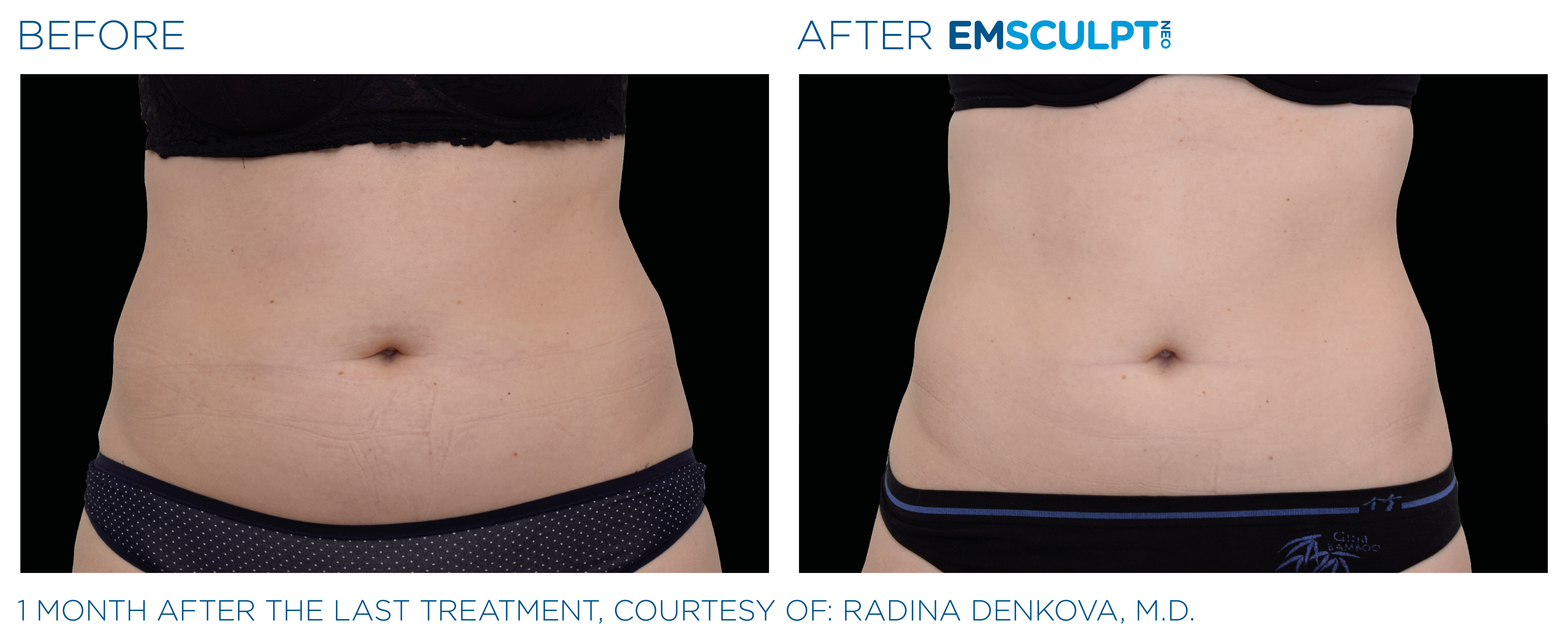 Emsculpt NEO - Body Shaping Treatment Costa Mesa, Newport Beach