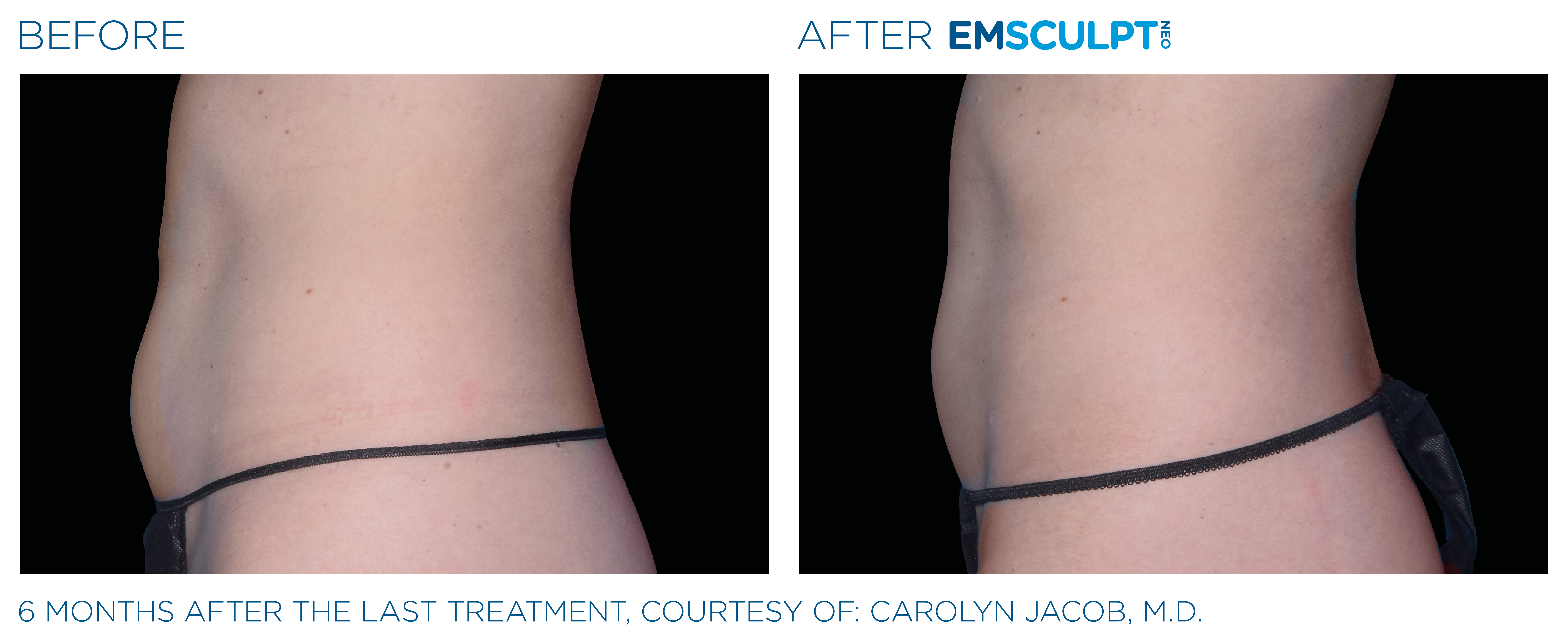 Emsculpt NEO - Body Shaping Treatment Costa Mesa, Newport Beach