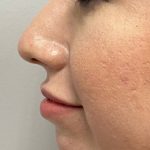 Non-surgical Nose Job Before & After Patient #9298