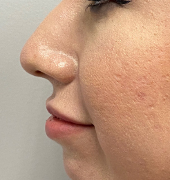 Non-surgical Nose Job Before & After Patient #9298