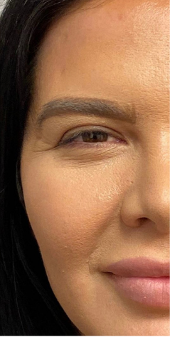 Xeomin Before & After Patient #9265