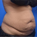 CoolSculpting Before & After Patient #9292