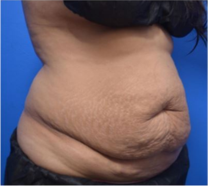CoolSculpting Before & After Patient #9292