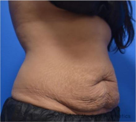 CoolSculpting Before & After Patient #9292