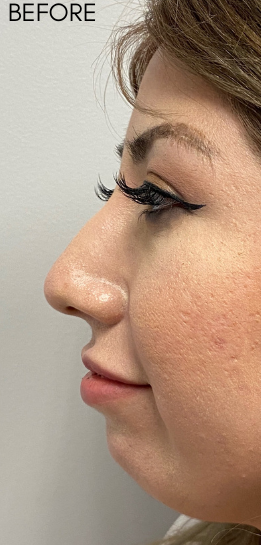 Chin Filler Before & After Patient #9298
