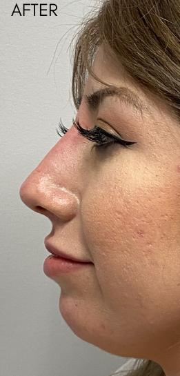 Chin Filler Before & After Patient #9298