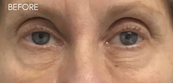 i Tyte Before & After Patient #9306