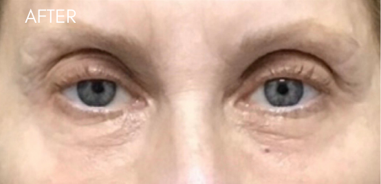 i Tyte Before & After Patient #9306
