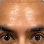 Botox, Dysport, & Xeomin Before & After Patient #9309