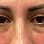 Restylane Lyft Before & After Patient #9312
