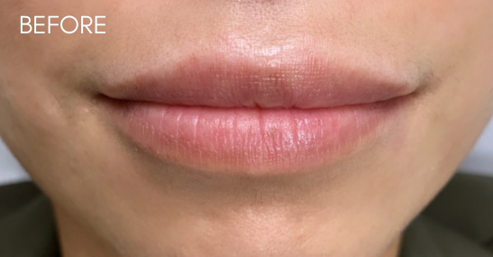 Restylane Kysse Before & After Patient #9268